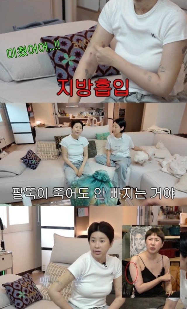 Seoinyoung Confesses to Full-Body Anesthesia Arm Liposuction: 